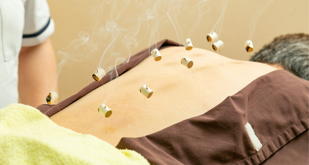 鍼治療とは何ですか?